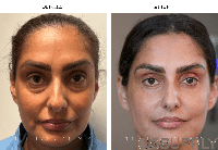 Bilateral Blepharoplasty Drape, No Pouch - Carton