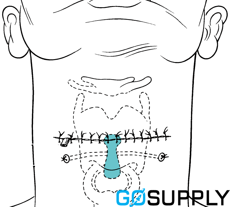 MONTGOMERY® LARYNGEAL STENT - Size: Small Adult Dimensions: 37 : 11 : 10